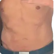 After treatment image of Barry w