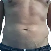 Before treatment image of Barry w