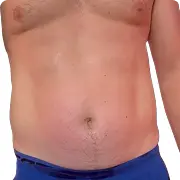 After treatment image of Chuck C.