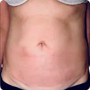 Before treatment image of JM.