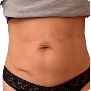 After treatment image of K.Z.