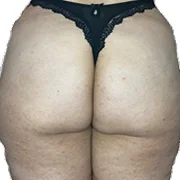 Before treatment image of Stephanie L.