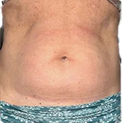 Before treatment image of T.Lopez