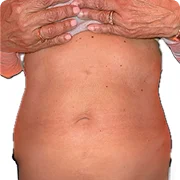 Before treatment image of Tasha H.